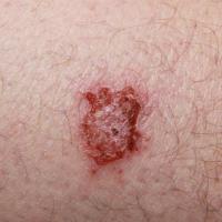 
	Discoid eczema