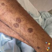 Discoid eczema
Copied with kind permission from…
