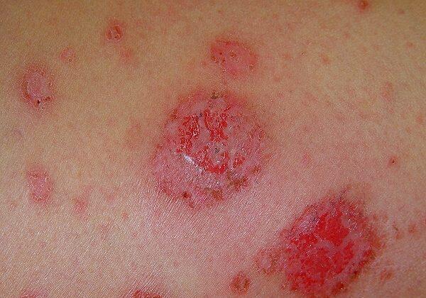 Discoid Eczema Nummular Eczema discoid-eczema-nummular-eczema