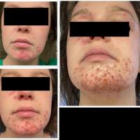 Eczema herperticum - initially treated as…