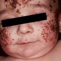 Eczema herpeticumSecondary infection with…