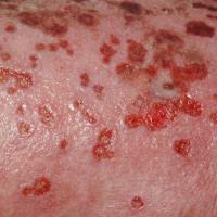 
	Eczema herpeticum:…