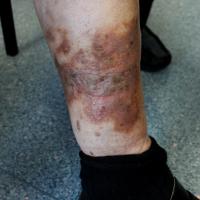 
	Gravitational eczema
	
	Symptoms developed some…