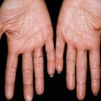 
	Contact irritant dermatitis

	Copied with kind…