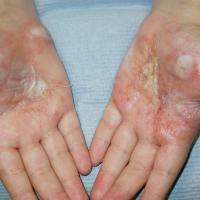 
	Pompholyx

	Large blisters