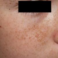 
	Freckles close-up