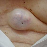 
	Epidermoid cyst&nbsp;
	
	Central punctum…