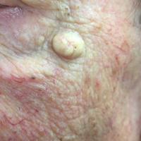 Epidermoid cyst
Copied with kind permission from…
