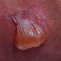 
	EB - a typical non-inflammatory blister
