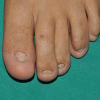 
	Dominant DEB - dystrophic nails

	Copied with…