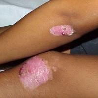 
	Dominant DEB - atrophic scarring

	&nbsp;