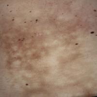 
	Erythema ab igne

	Image copied with kind…