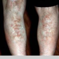 
	Erythema ab igne