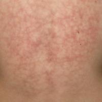 
	Erythema ab igne