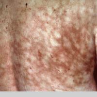 
	Erythema ab igne