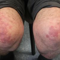 
	Erythema elevatum diutinum