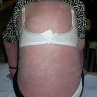 
	Erythroderma secondary to eczema