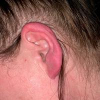 
	As previous image

	Ears affected&nbsp;