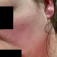 
	As previous image

	Face affected&nbsp;