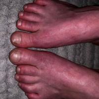 
	As previous image

	Feet become dusky red…
