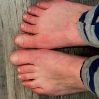 
	Erythromelalgia - early stage of a flare