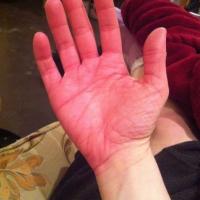 
	Erythromelalgia in a different patient
