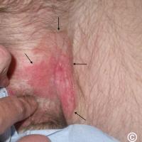 Extramammary Paget disease of the scrotum and…