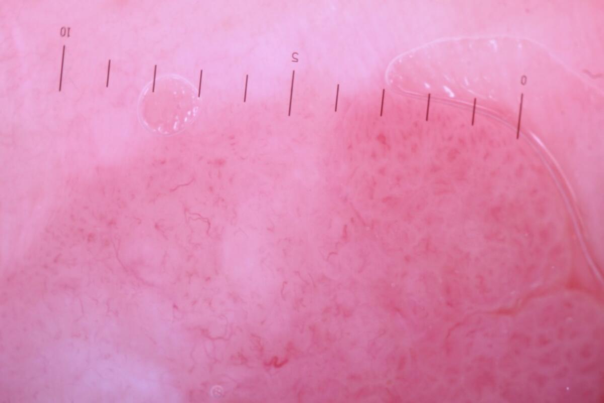 Fep Derm Fibroepithelioma of Pinkus