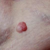 
	Fibroepithelioma of Pinkus and BCC