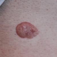 
	Fibroepithelioma of Pinkus and BCC

	Image…