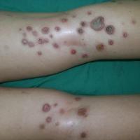 
	Acquired perforating dermatosis&nbsp;