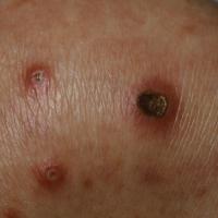 
	Acquired perforating dermatosis