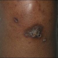 
	Acquired perforating dermatosis

	A larger…
