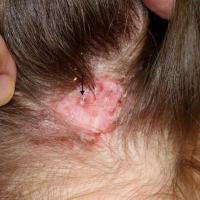 
	Folliculitis decalvans

	Pustules present…