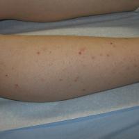 
	Folliculitis on legs caused by shaving