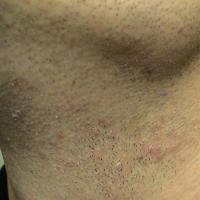 
	Pseudofolliculitis&nbsp;