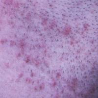 Pseudofolliculitis close-up