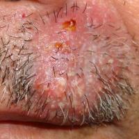 
	Sycosis barbae