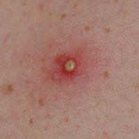 
	Folliculitis

	Copied with kind permission from…