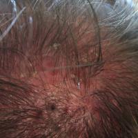 
	Folliculitis decalvans

	Arrow denotes…