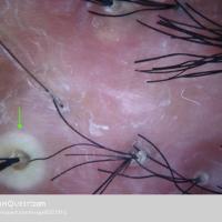 
	Folliculitis decalvans

	Pustules present…