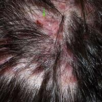
	Folliculitis decalvans
	
	Pustules present…