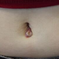 Retained Ethibond suture This is a…