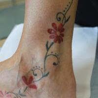  Post-treatment with intralesional steroid…