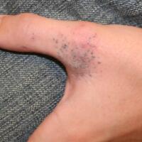  An accidental tattoo caused by a gunpowder…