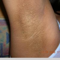 
	Fox-Fordyce disease&nbsp;