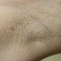 
	Fox-Fordyce disease