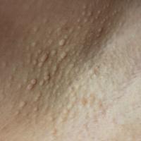 
	Fox-Fordyce disease
