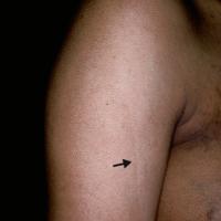 
	Pigmentary demarcation lines