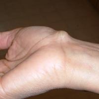 
	Ganglion